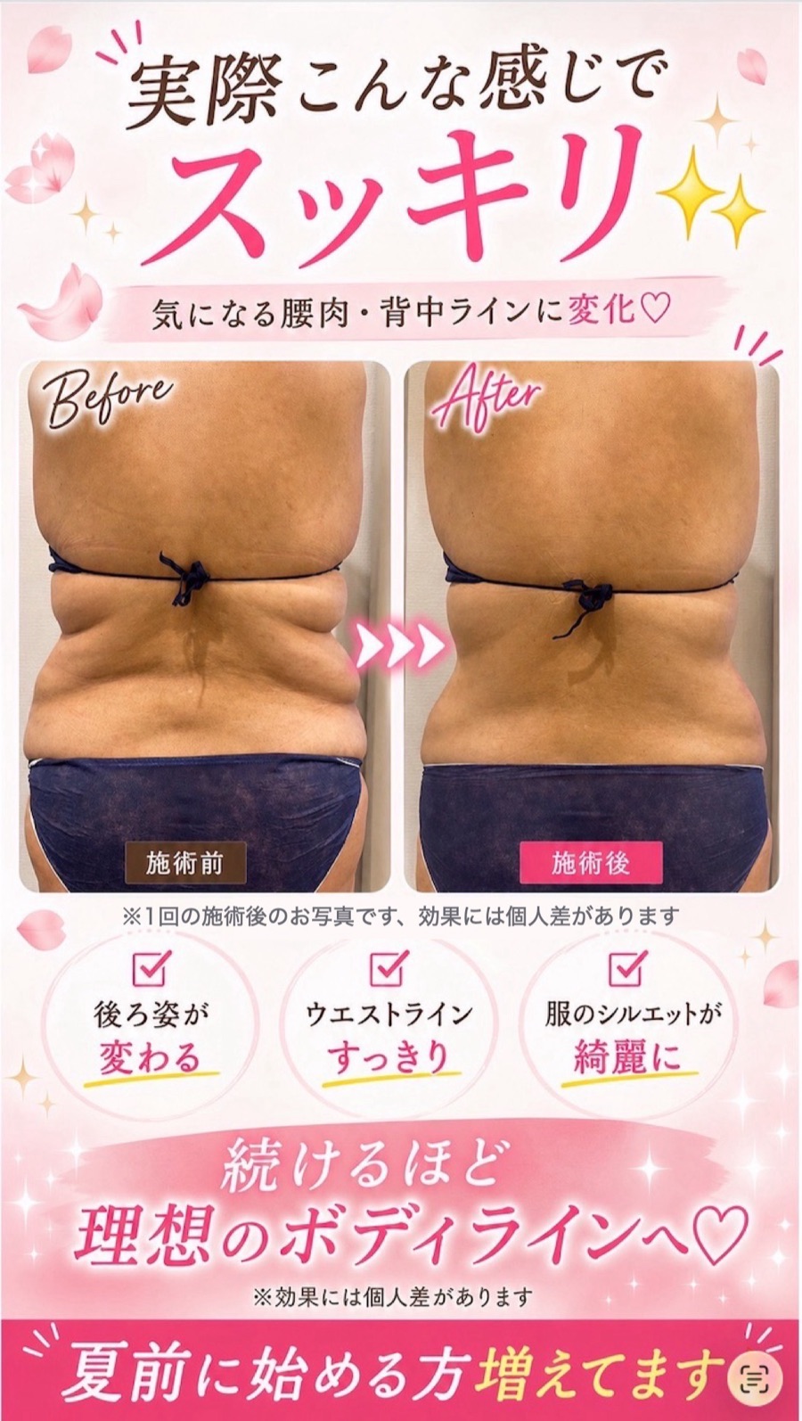 施術ビフォーアフター（腰肉・背中ライン）※1回の施術の効果です／効果には個人差があります